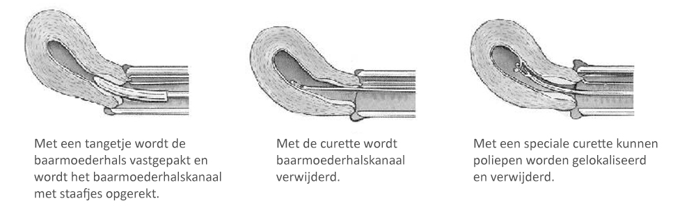 Curettage in 3 afbeeldingen